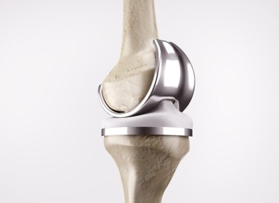 Kneprotese i CoCrMo